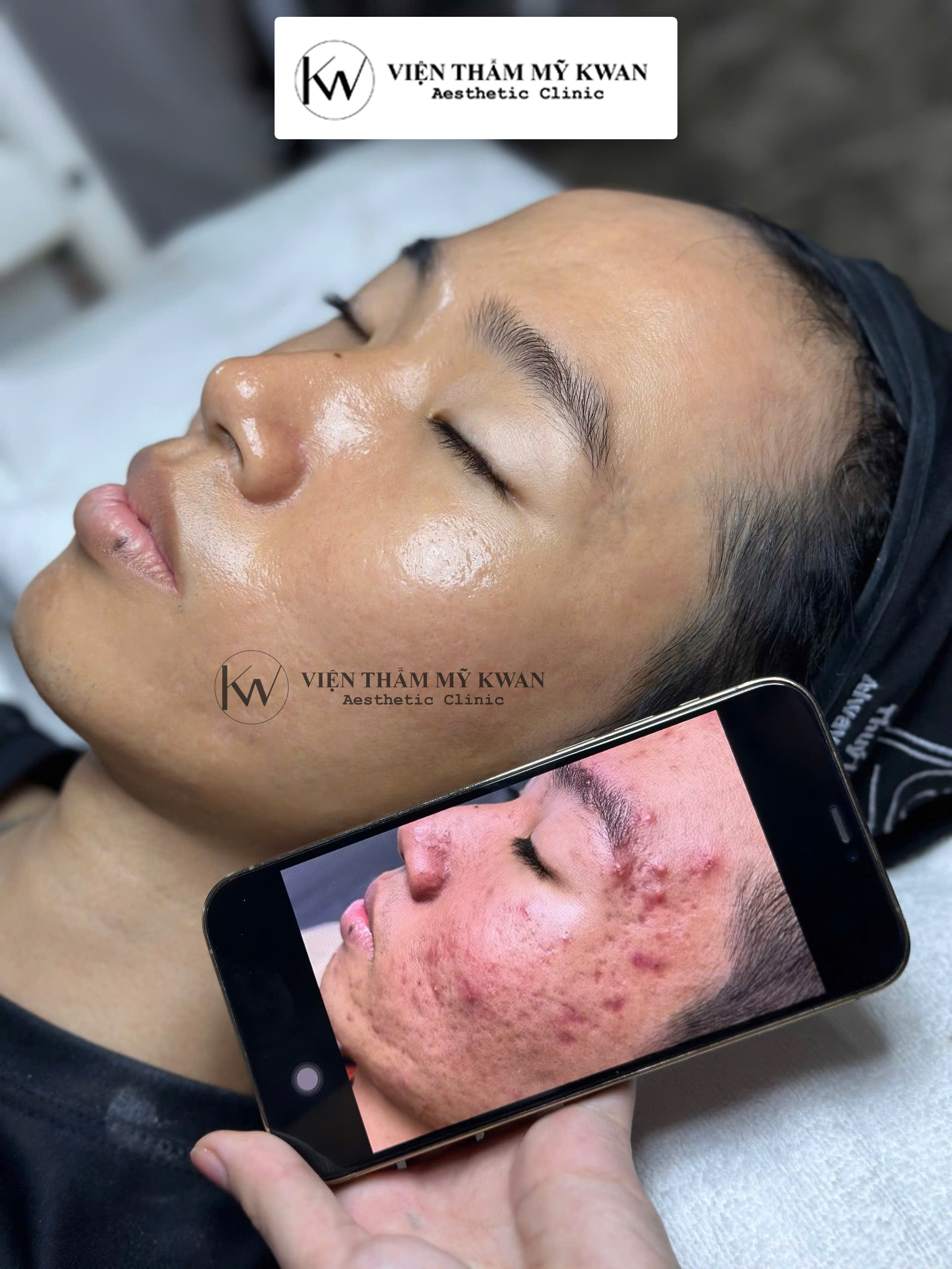 Chemical Peel