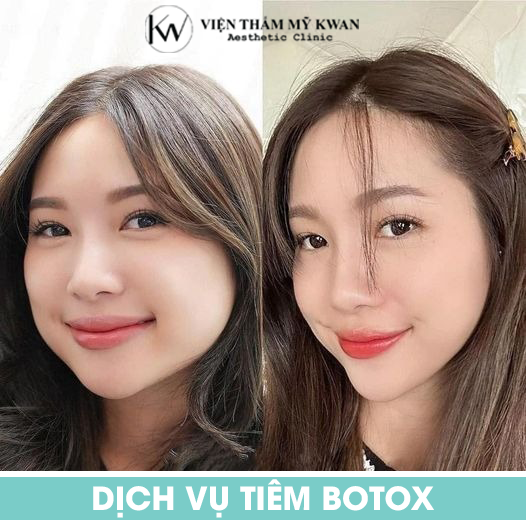 dịch vụ tiêm Botox