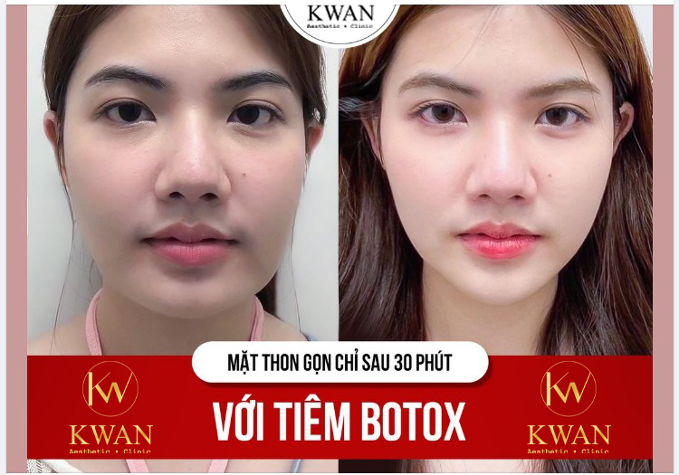 dịch vụ tiêm Botox