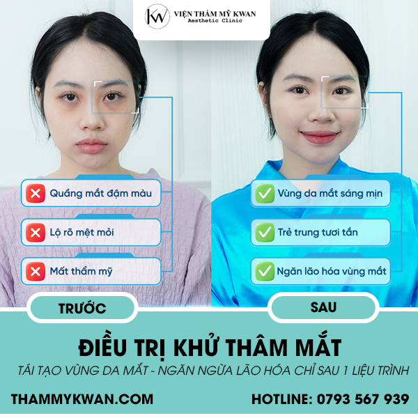 Điều trị khử thâm mắt