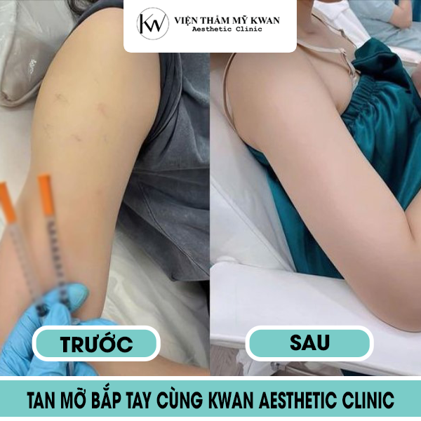 Dịch vụ tiêm tan mỡ