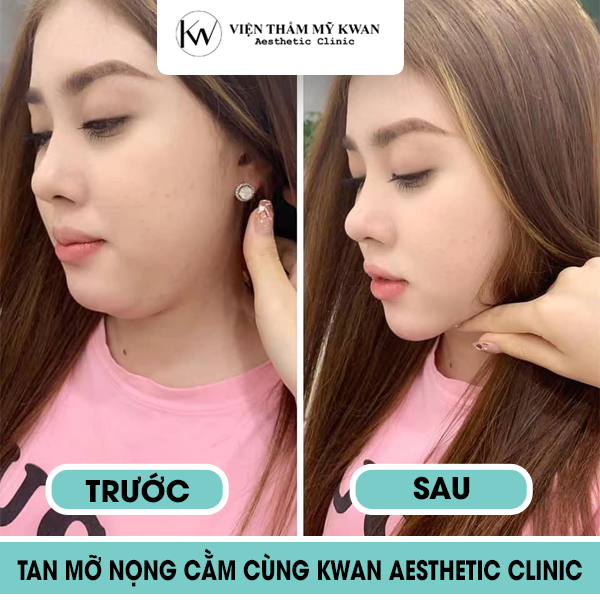 Dịch vụ tiêm tan mỡ