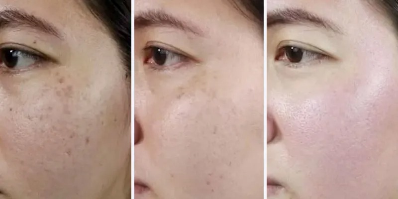 Viện thẩm mỹ trị nám