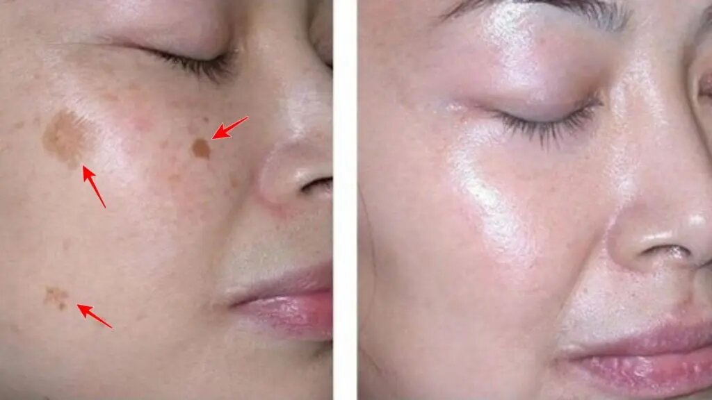 Viện thẩm mỹ trị nám