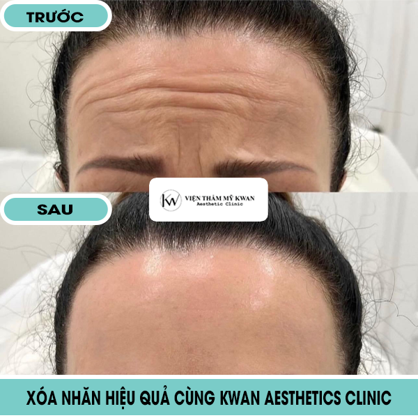 xóa nếp nhăn