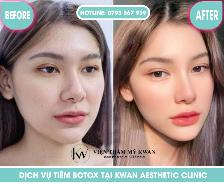 Dịch vụ tiêm Botox