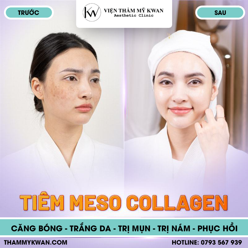 Dịch vụ tiêm Meso