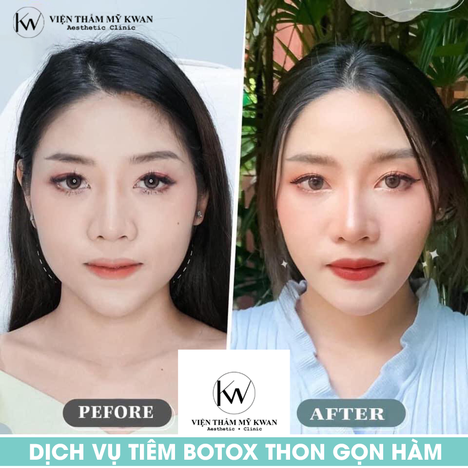 dịch vụ tiêm Botox